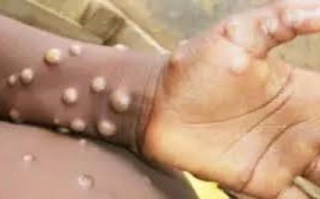 Mpox: A Global Health Challenge