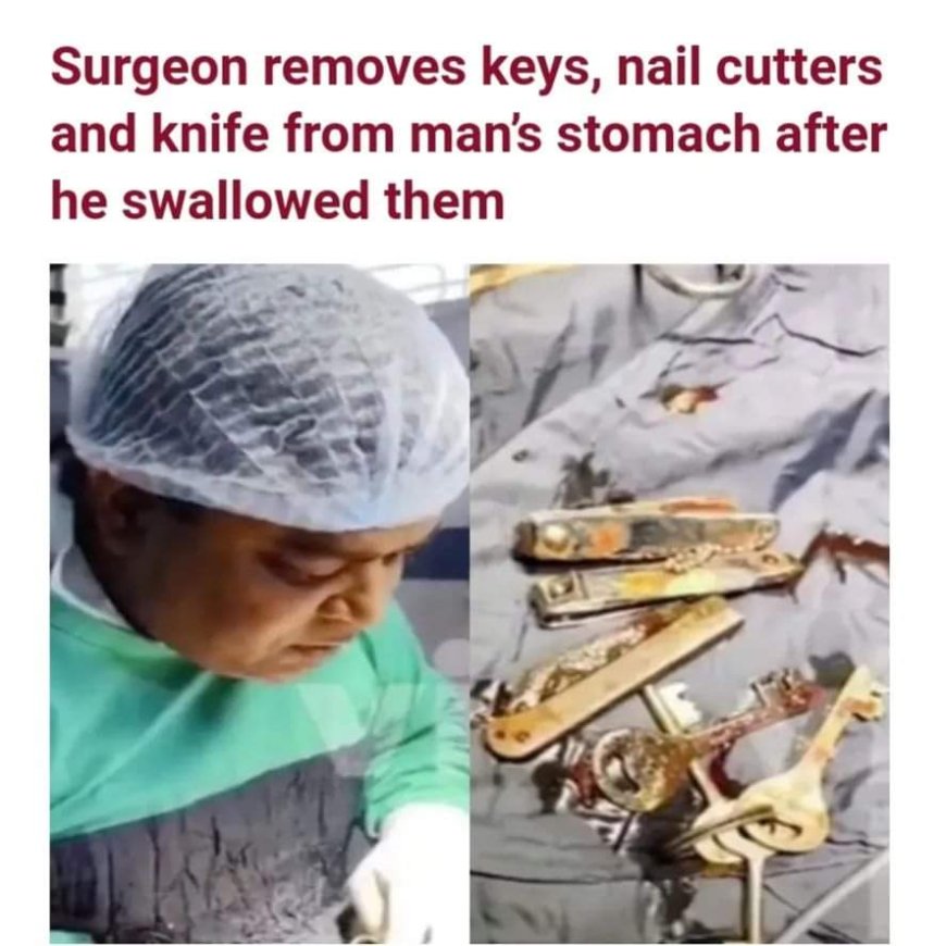 Doctors in India were shocked to find keys, nail clippers, and even a knife from the stomach of a man, reported to be in his early twenties.