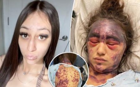 Woman with rare disease claims she’s now blind and bruised after doctors made her get 3 vaccines (photos)