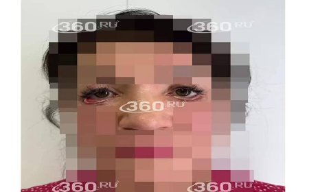 A woman was left unable to close her eyes after undergoing plastic surgery that was done by a ‘bogus’ Russian medic.