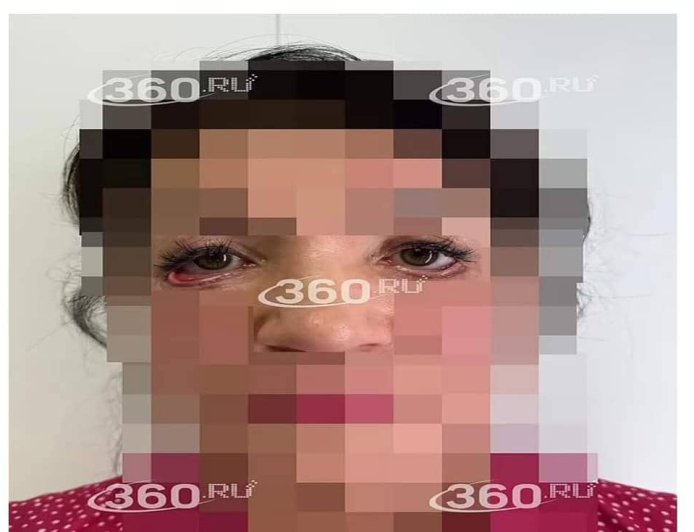 A woman was left unable to close her eyes after undergoing plastic surgery that was done by a ‘bogus’ Russian medic.