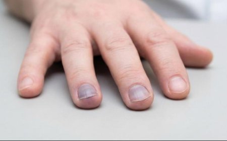 Cyanosis is a bluish or purplish discoloration of the skin, lips, tongue, or nail beds caused by an increased amount of deoxygenated hemoglobin in the blood.