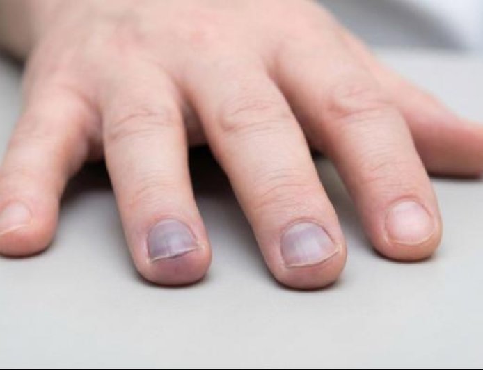 Cyanosis is a bluish or purplish discoloration of the skin, lips, tongue, or nail beds caused by an increased amount of deoxygenated hemoglobin in the blood.