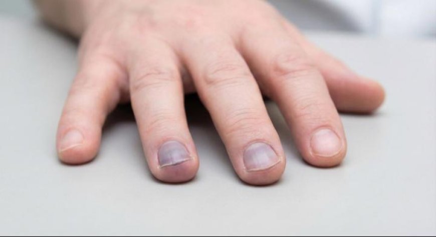 Cyanosis is a bluish or purplish discoloration of the skin, lips, tongue, or nail beds caused by an increased amount of deoxygenated hemoglobin in the blood.